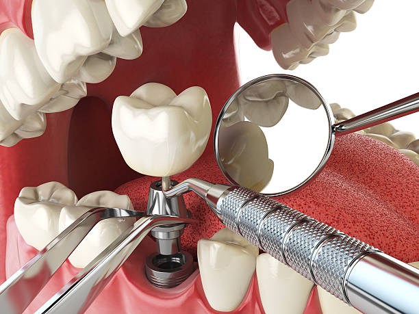 Best Emergency Tooth Extraction in Holyoke, CO